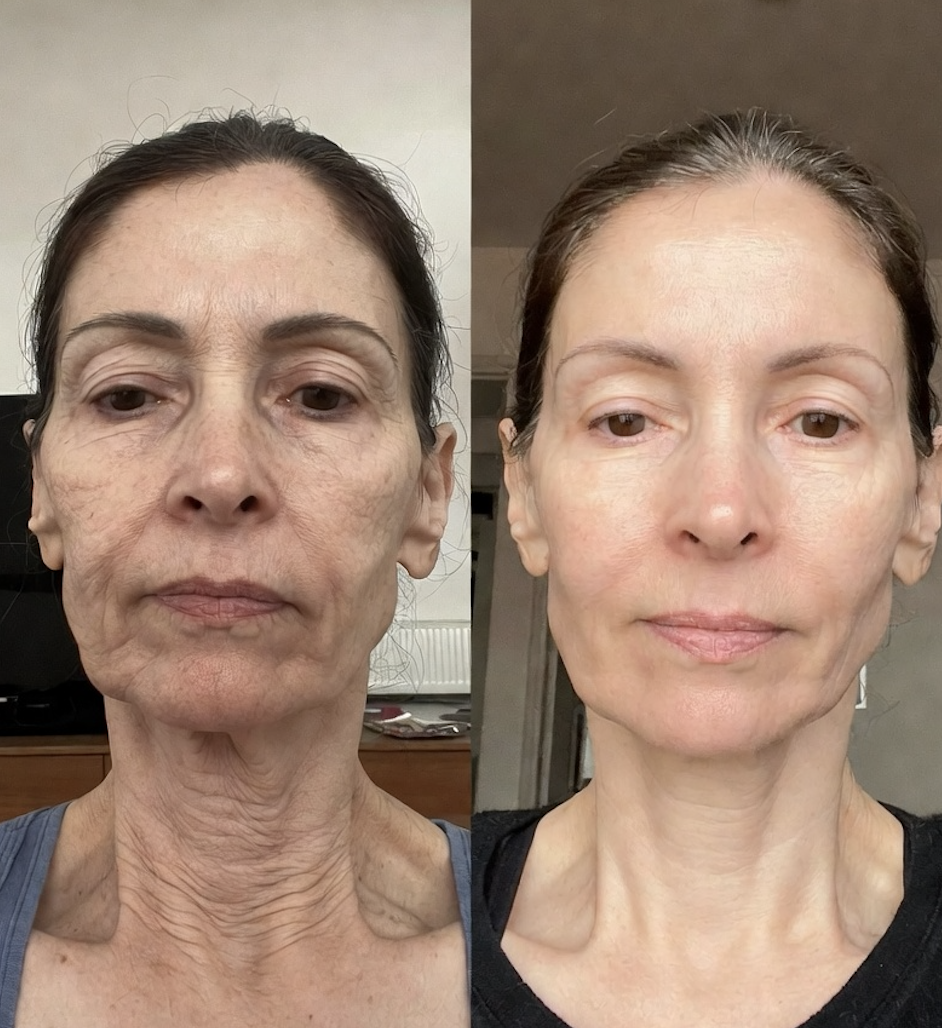 Antes e depois de pele