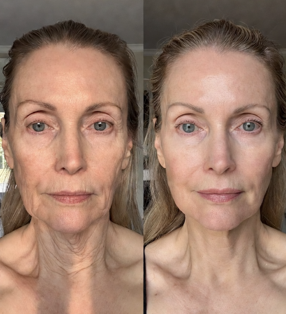 Antes e depois Maria 56