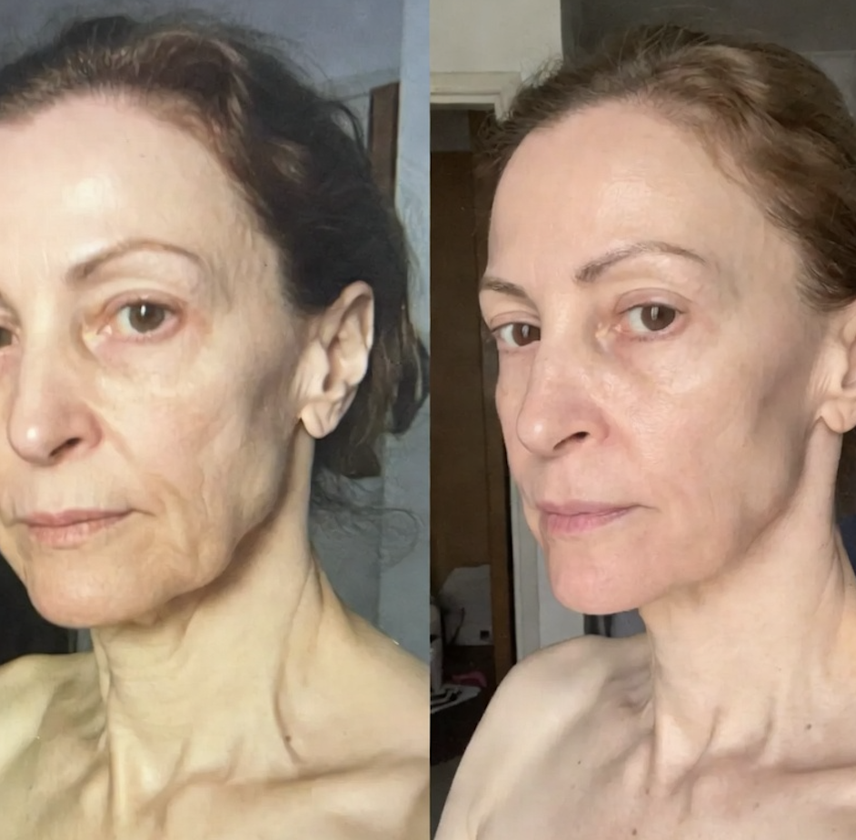 Antes e depois Marlene